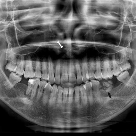 Showing Swelling In The Left Buccal Mucosa With White Surface