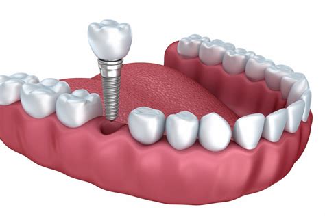 dental implants ballymena smiles dental care