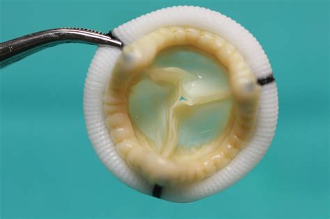 Heart Valve Picture 1