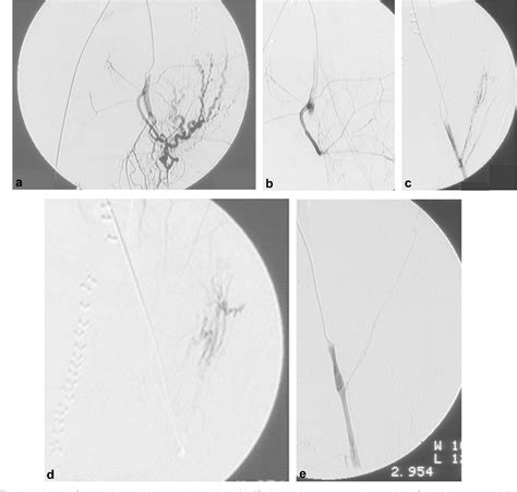 Round Ligament Of The Uterus Semantic Scholar