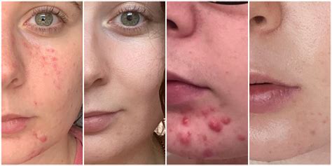 How Can I Clear Up Acne Fast Mastery Wiki