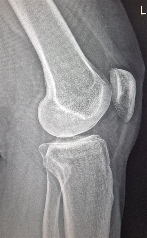 Knee Lateral View Rradiology