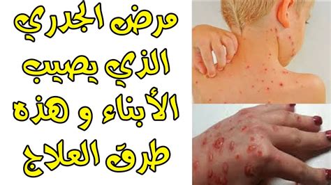 الاسهال عند الاطفال أسبابه وأعراضه وعلاجه. مرض الجدري , ماهو مرض الجدري واسبابه وعلاجه - المميز