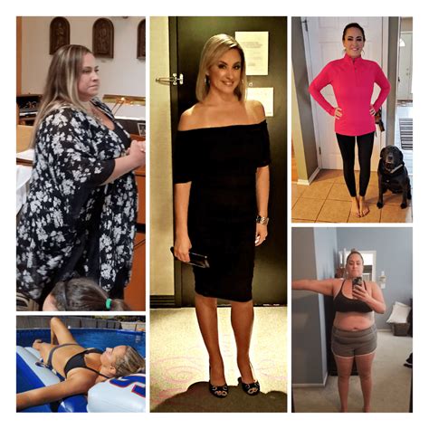 Shore Woman Changes Her Lifestyle Degrees After Weight Loss Surgery Prime Surgicare