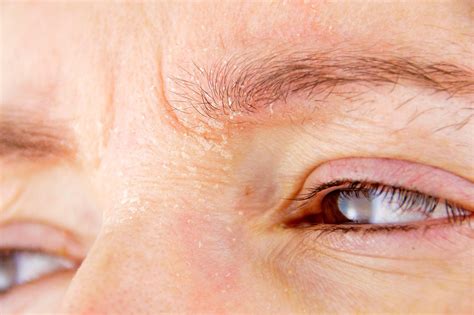 Eyebrow Dandruff Why It Happens And How To Get Rid Of It The Healthy