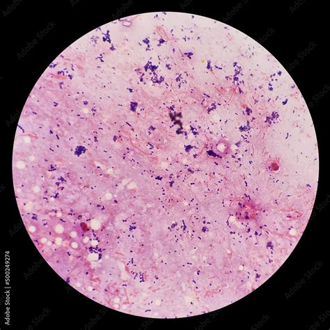 Cocci And Bacilli Bacteria In Urine Under 100x Light Microscope Smear