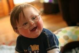 It has been reported that almost half of the patients with down syndrome have mild to severe eye diseases. DOWN'S SYNDROME: WORLD DOWN'S SYNDROME DAY--- 21ST MARCH