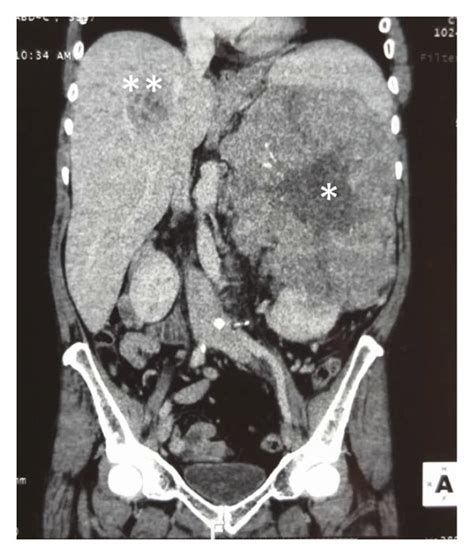 Contrast Enhanced Ct Abdomen Chest And Pelvis A Coronal Image And