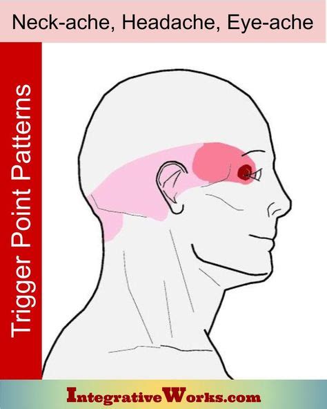 Eye Trigger Point Pain