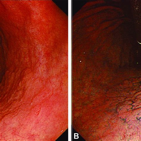 Early Gastric Cancer A A Depressed Lesion Was Noted At The Antrum