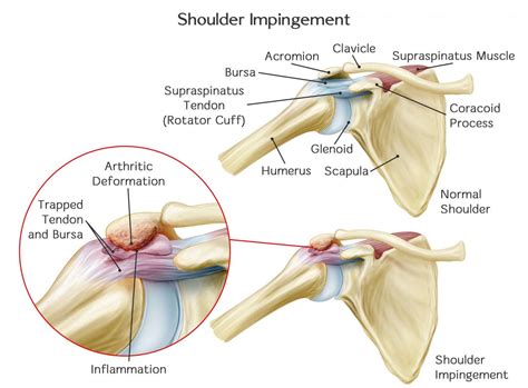 Typically overuse/repetitive strain injury, multifactorial and complex. S3C Blog - Subacromial Impingement & Pain Syndrome