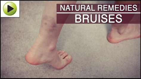 Skin Care Bruises Natural Ayurvedic Home Remedies Youtube