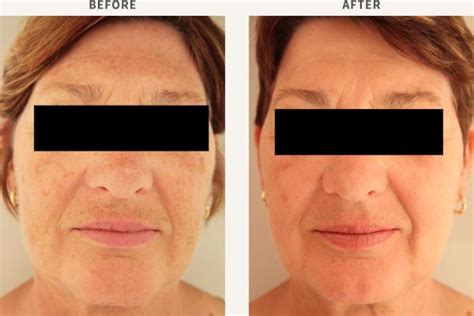 Ipl Photo Rejuvenation For Face Chest And Hands Sydney Dermatology Group