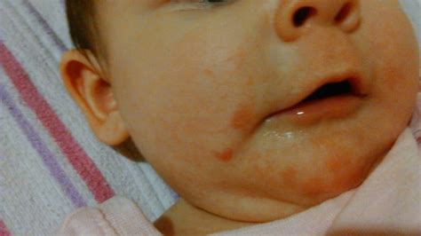 Is This A Teething Rash September 2014 Babycenter Australia