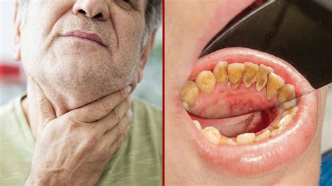 What Does Mouth Cancer Look Like On Tongue