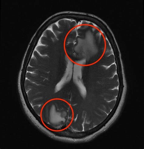 Craniotomy For Brain Tumor Resection — Institute Of Neuro Innovation