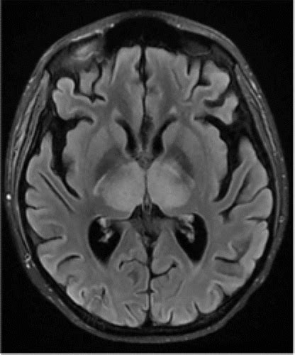 Case 279 Central Variant Posterior Reversible Encephalopathy Syndrome