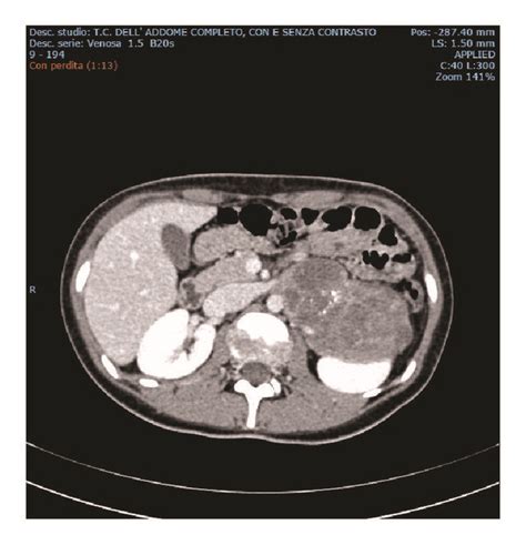 Abdominal Ct Scan With And Without Contrast Enhancement Presence Of A