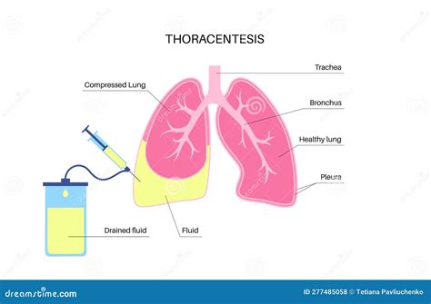 Thoracentesis Medical Procedure Stock Vector Illustration Of Medical
