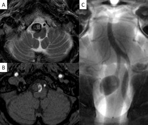 Axial Views Of Mri T2 Weighted Image A And Time Of Flight B Shows