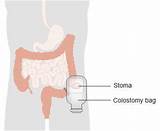 Colostomy Medical Definition