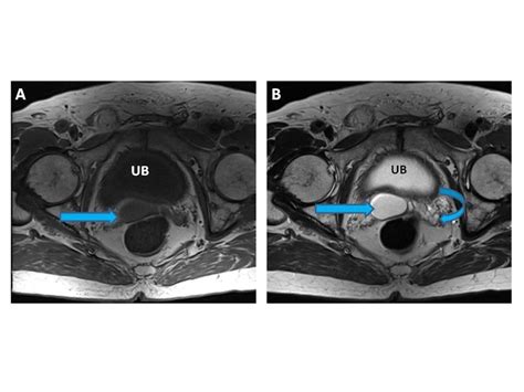 Seminal Vesicle Cyst Ct And Mri Findings Eurorad