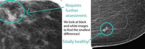 Let’s Talk About Breast Calcifications Worry Or Not Diagnostic Imaging Centers Kc