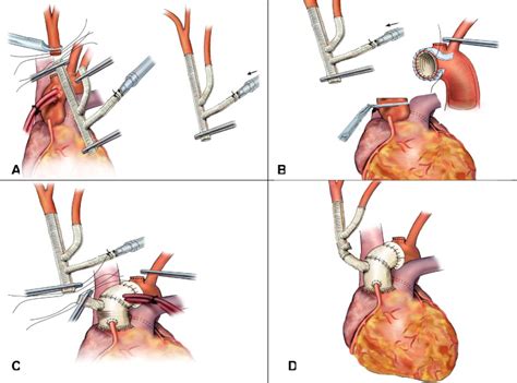 Simplified Technique Of Total Aortic Arch Replacement With Minimal