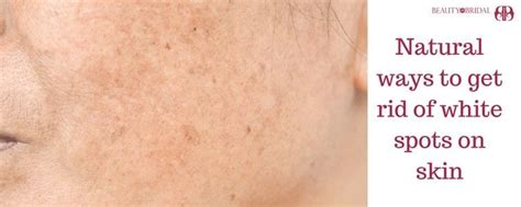 White Spots On Skin Fungus Archives Beauty Services At Home