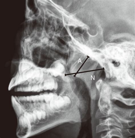 Method Of Assessing Adenoid Enlargement On Lateral Neck Radiography In
