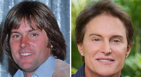 The stigma surrounding plastic surgery is disappearing as more mothers share their experiences, and why surg. Bruce Jenner Facelift Plastic Surgery Before and After ...