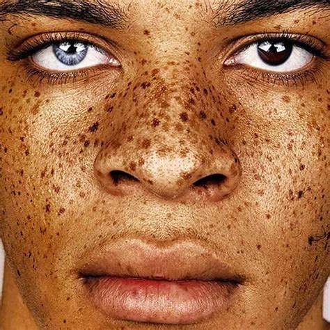 Stunning Portraits Beauty Of Freckles Zecca Cosmedical