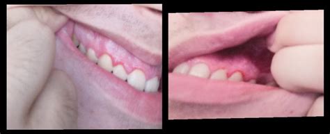 What Are These White Spots On My Gums Dentistry