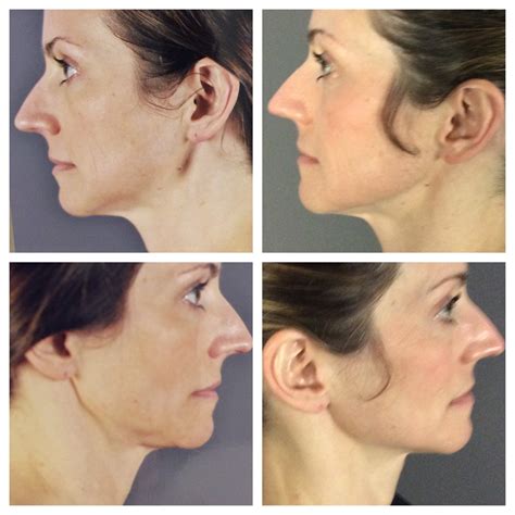 Mark Jewell MD Awesome Ultherapy Results One Year Later Mark Jewell MD