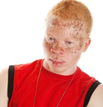 Albinism As Related To Down Syndrome Pictures