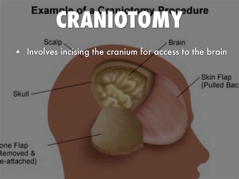 Craniotomy By Nakeeyagoff