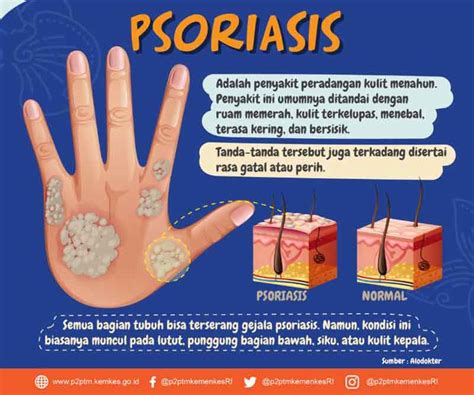 Selain itu, pasien penderita hepatitis autoimun juga dapat diberikan azathioprine, mycophenolate, tacrolimus, dan cyclosporin. Apa Itu Psoriasis? Apa Gejala dan Penyebabnya?
