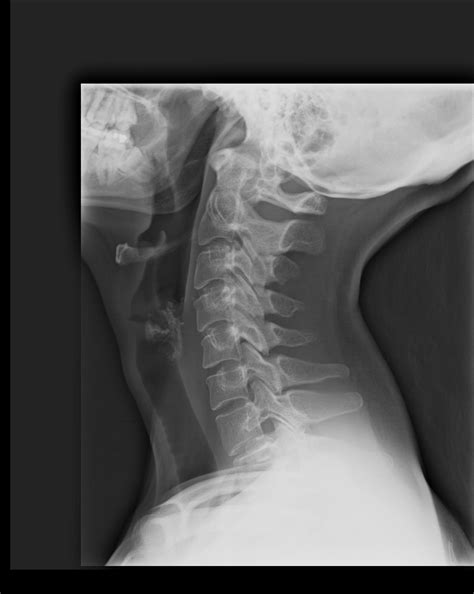 Imagem Da Coluna Cervical