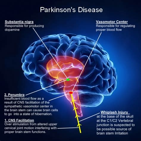 Parkinsons Disease Symptoms Parkinsons Symptoms Four Main Signs Of