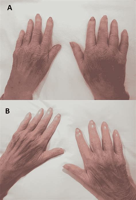 The Images Show A Bluish Discoloration And Swelling Of Both Hands