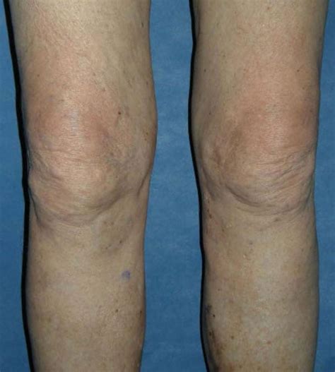 Blue Veins Treatment Causes And Prevention In Jacksonville Florida