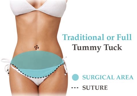 Cost Of Tummy Tuck Surgery Benefits Results Etc