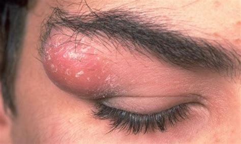 Cyst On Forehead Causes Symptoms Pictures Sebaceous Cyst White