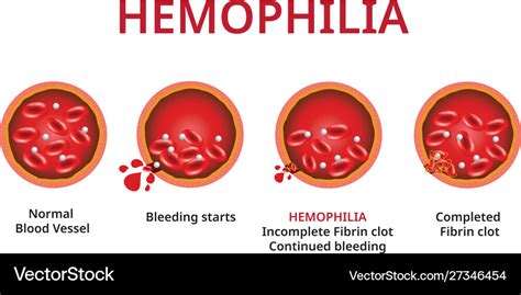Hemophilia Damaged Blood Vessel Haemophilia Vector Image