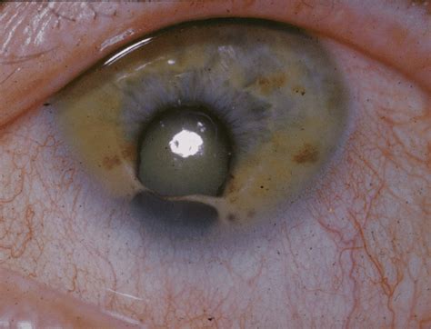 Cat Eye Syndrome Biological Science Picture Directory