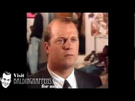 Stress, hormone changes and some medications often manifest side effects such as hair loss and unexplained weight loss, according to merck. Michael Chiklis Hair Loss - YouTube