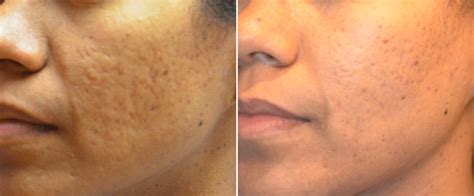 Microneedling On Dark Skin How To Safely Get The Results You Want