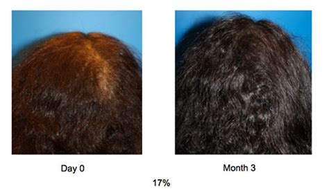 Hair Loss Treatments With Acell Prp Ozone Park Howard Beach New York