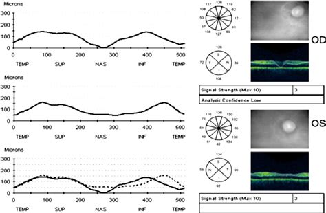 Optical Coherence Tomography Recording Around The Optic Nerve Head