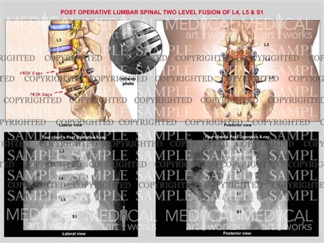 2 Level L4 L5 S1 Lumbar Interbody Fusion With Post Op X Rays